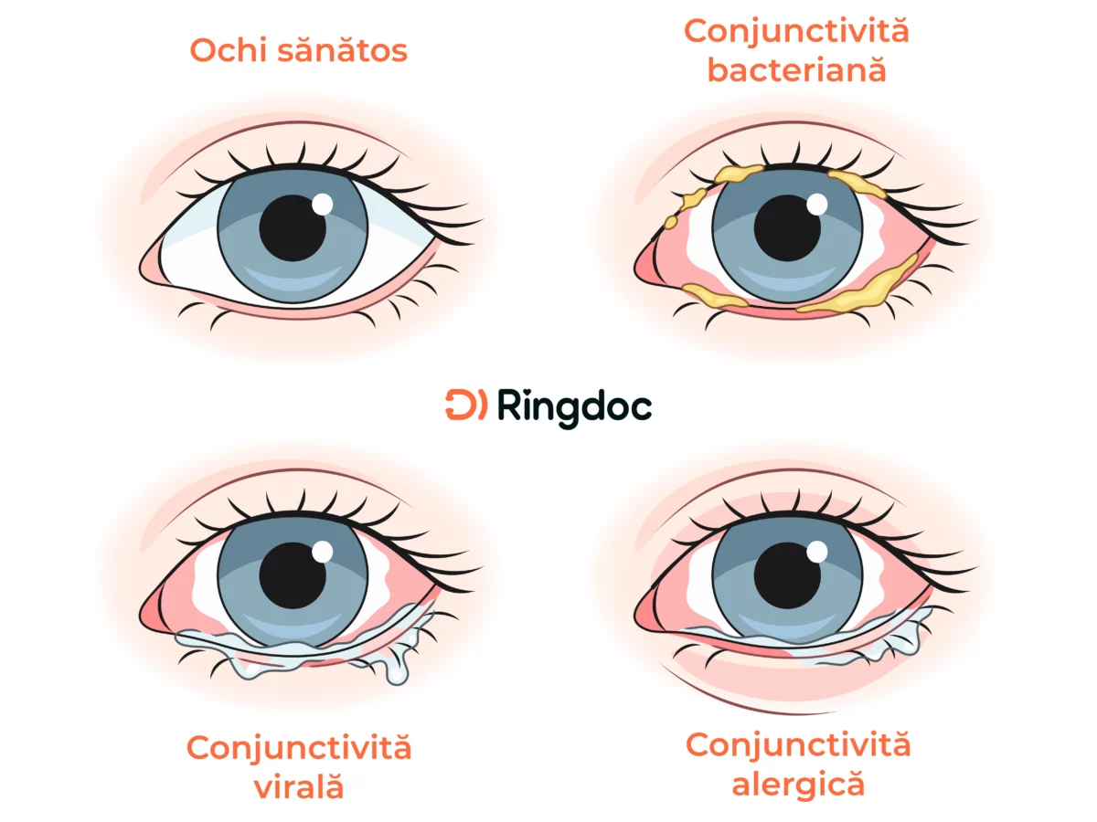Tipuri de conjunctivită: conjunctivită bacteriană, conjunctivită virală, conjunctivită alergică