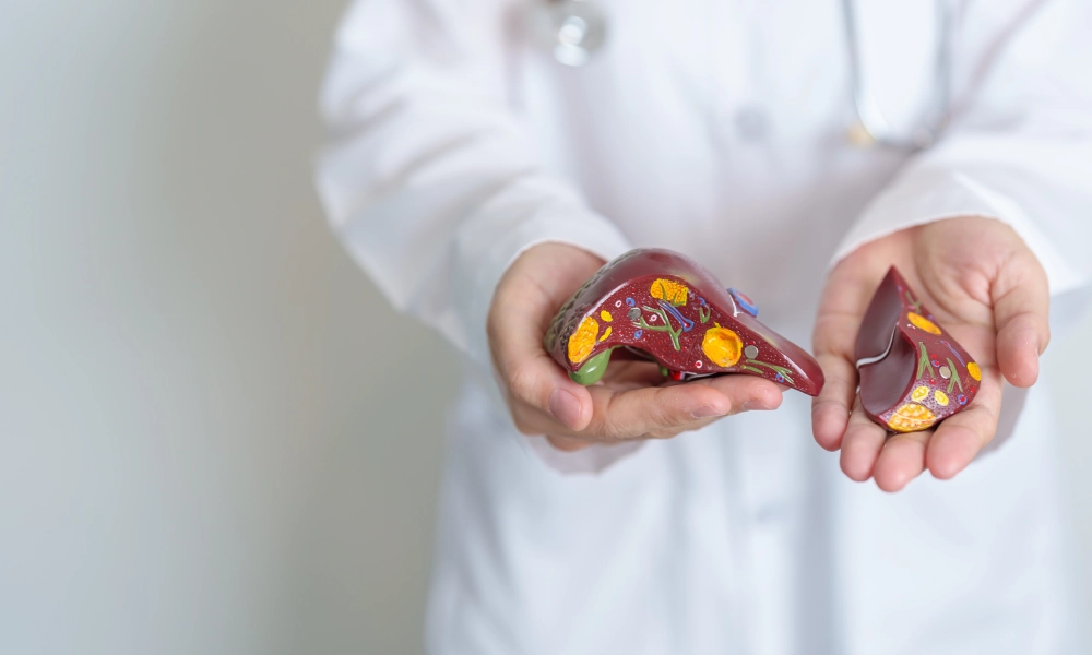 Boala ficatului gras non-alcoolic – cauze, simptome, prevenire