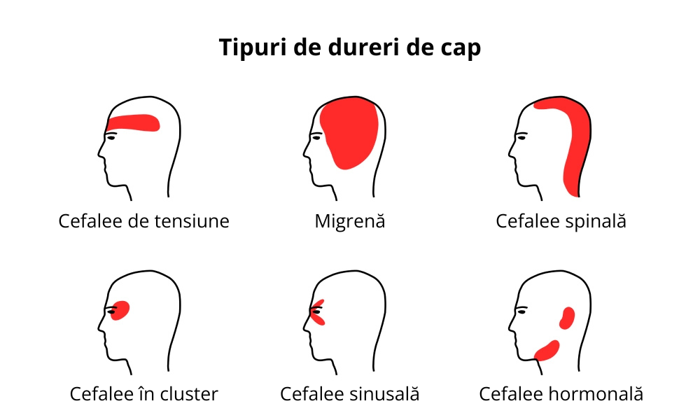 Tipuri de dureri de cap