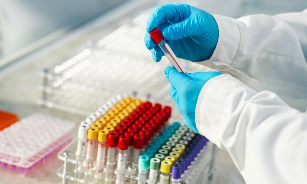 Hemograma completă: ce este, ce analizează și cum se interpretează. Explicații simple pentru leucocite, hemoglobină și alte valori.