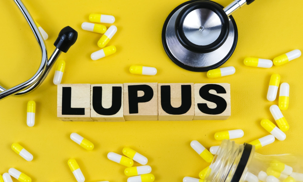 Lupus: simptome, cauze, simptome, diagnostic și tratament