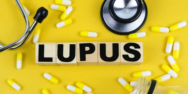 Lupus: simptome, cauze, simptome, diagnostic și tratament